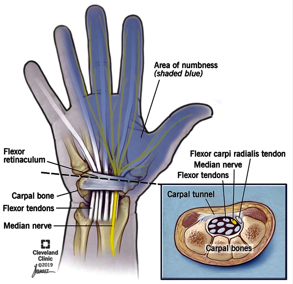 Carpal tunnel syndrome: The invisible threat - Philippine Morning Post